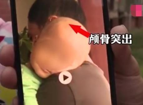 湖南梆州再现“大头娃娃”，涉案“奶粉”原来只是固体饮料？